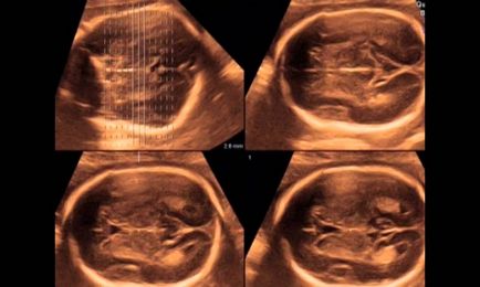 Normele Tabelul fetometry fetus de săptămâni, idealul I (fetometry) Normele Tabelul fetometry fat de săptămâni, I ideală