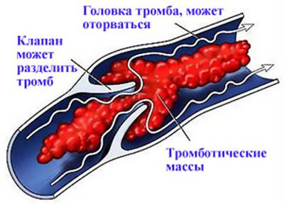 prognosticul embolismului pulmonar, cauze, clinice și de prim ajutor