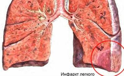 prognosticul embolismului pulmonar, cauze, clinice și de prim ajutor