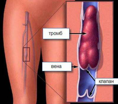 prognosticul embolismului pulmonar, cauze, clinice și de prim ajutor