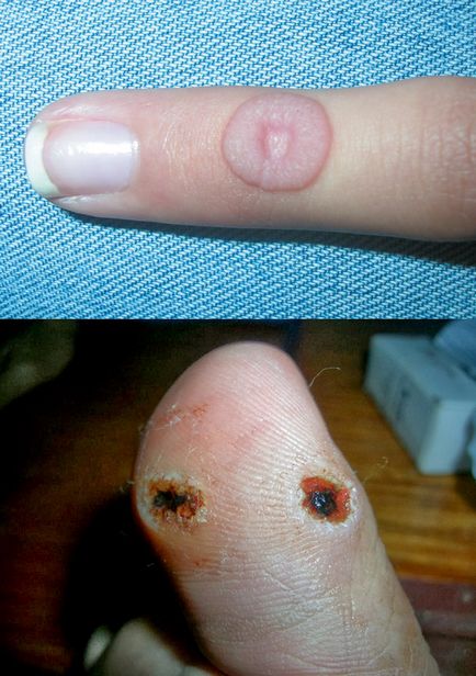 Prin îndepărtarea verucilor cu azot lichid (indepartarea veruca plantară crio azot lichid) Prin îndepărtarea verucilor cu azot lichid