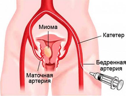 îndepărtarea fibroamelor