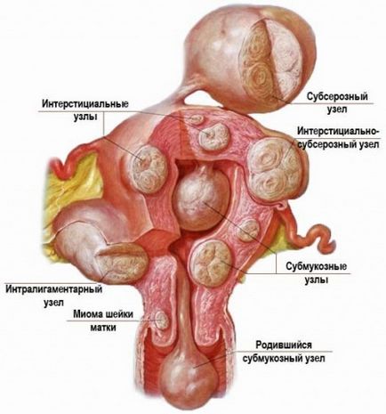 îndepărtarea fibroamelor