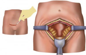 Eliminarea fibrom uterin, care este o modalitate mai bună