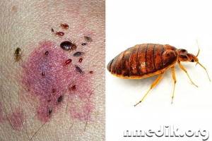 mușcături de insecte - simptome de sevraj si de tratament