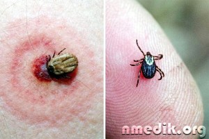 mușcături de insecte - simptome de sevraj si de tratament