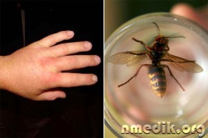 mușcături de insecte - simptome de sevraj si de tratament