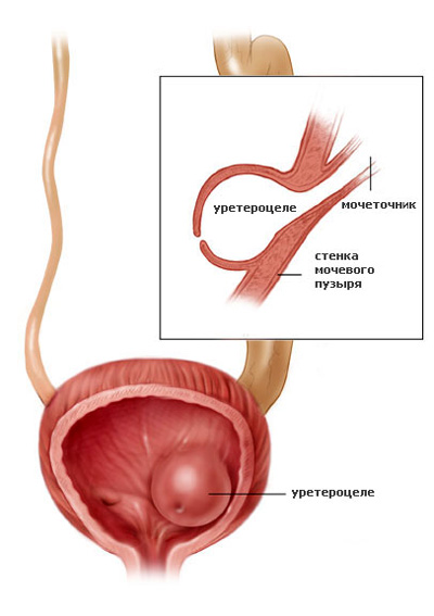 Ureterocelului la femei cauze, simptome si tratamentul bolii