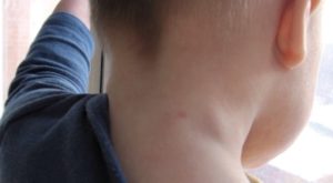 ganglionilor limfatici în gâtul copilului simptome, cauze, tratament