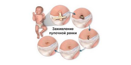 Îngrijirea plăgii ombilical nou-născut