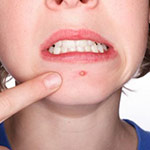 Tipuri de acnee, clinica medicala