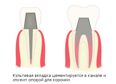 Tipuri de tab-uri de pe dinte de coroana și caracteristicile lor