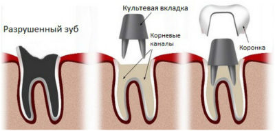 Tipuri de tab-uri de pe dinte de coroana și caracteristicile lor