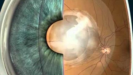 cataractă secundară după înlocuirea tratamentului lentile, diagnostic, simptome