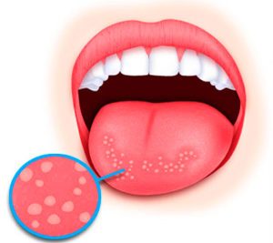 Ulcer pe limba - decât vindecarea, cauzelor, de răni pe limba copilului