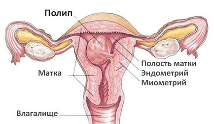 Fibroasă polip glandular endometrial, care este, cauzele, tratament