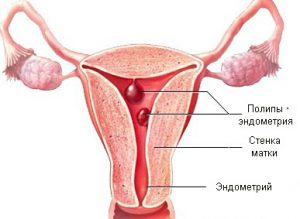 glandulară diagnostic polip endometrial fibroasa si tratament