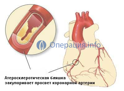 Bypass coronarian, chirurgie bypass coronarian pe inima
