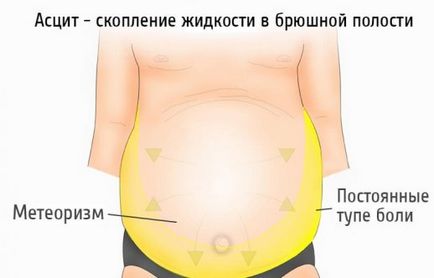 Din care fluidul în abdomen Din care fluidul în abdomen