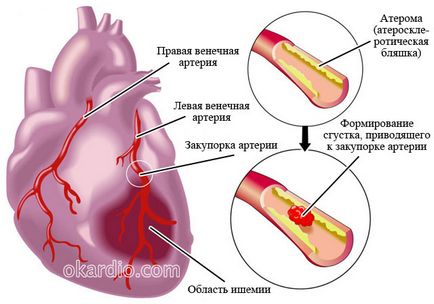 Ateroscleroza a aortei că este
