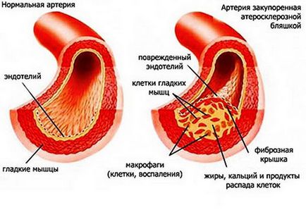 Ateroscleroza a aortei că este