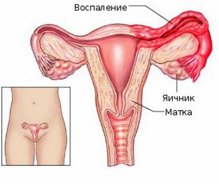 Inflamatia trata apendicelor Inflamatia trata apendicelor