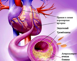 Ce este ateroscleroza aortei