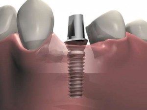 Ce sunt implanturile dentare și cum se întâmplă