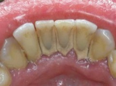 Ce este placa, deoarece face ceea ce este placa periculoasa clinica dentara mai