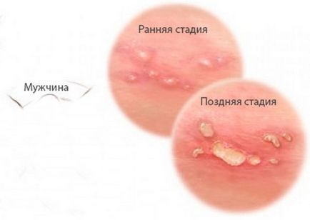 Herpes la bărbați și cum