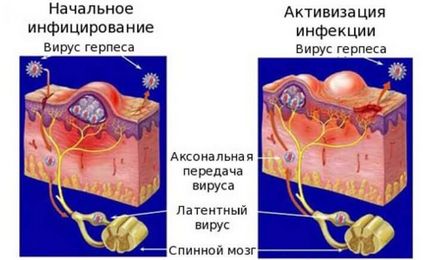 Herpes la bărbați și cum