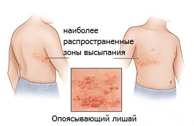 Tratamentul Herpes zoster