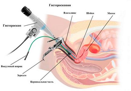 Hysteroresectoscopy ce este