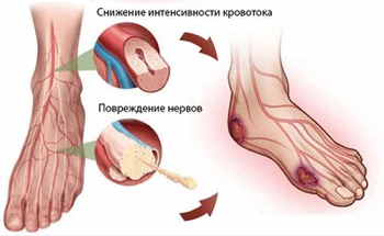 Accident vascular cerebral la barbati