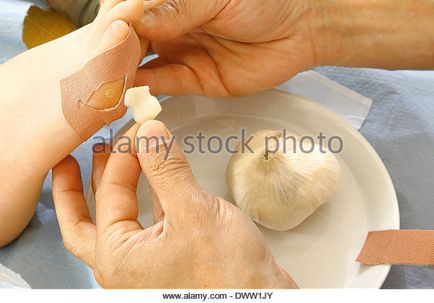 Cum sa scapi de veruci plantare Cum sa scapi de veruci plantare