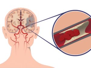 un al doilea accident vascular cerebral