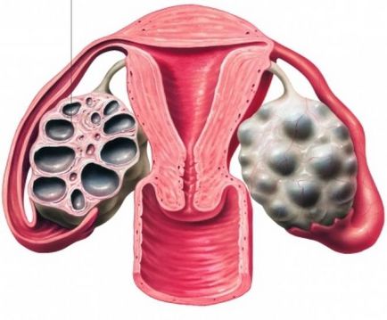 Ce este ovar multifollikulyarny