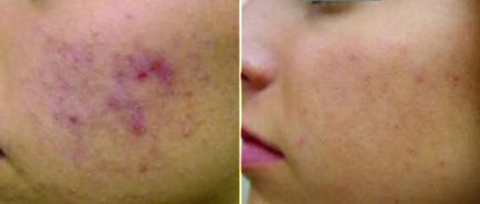 Tratamentul cu laser de acnee