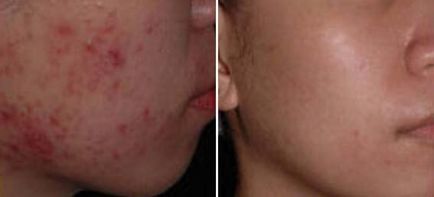 Tratamentul cu laser de acnee