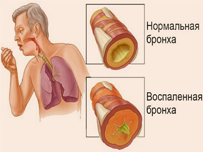 Tratamentul pentru bronșită