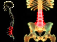 Tratamentul sciatica lumbosacral