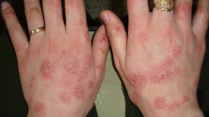 Pe ce mâinile inflamat Pe ce mâinile inflamat