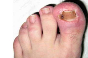 Un abces pe unghii deget de la picior lângă tratamentul de droguri și remedii populare, cauze și măsuri