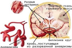 Cerebral tratament tulburări circulatorii