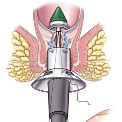 tratamentul chirurgical