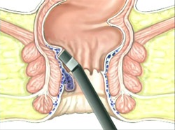 tratamentul chirurgical