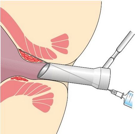 tratamentul chirurgical