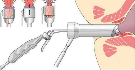 tratamentul chirurgical