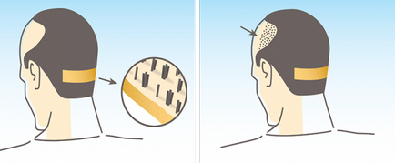 Cum să transplant de păr