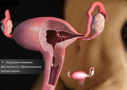 Hysteroresectoscopy ce este